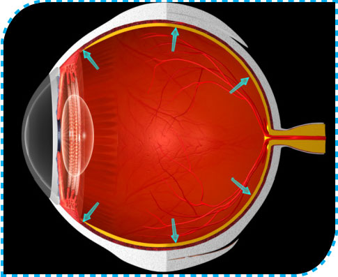 Glaucoma