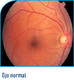 Retinopatía diabética